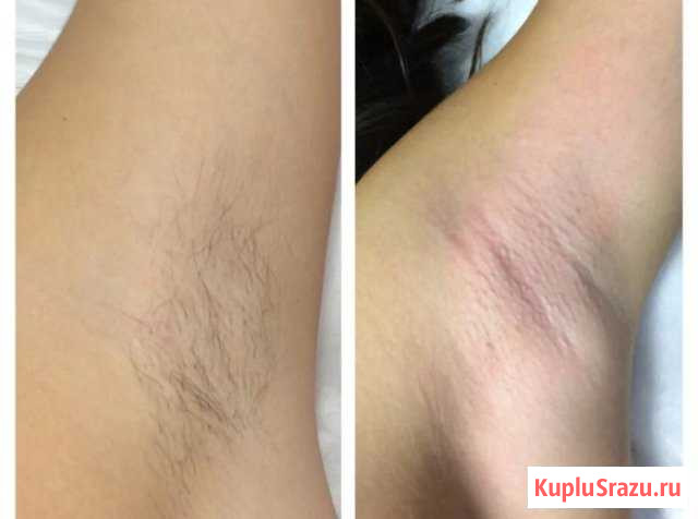 Шугаринг в Люберцах. (Возможен выезд на дом) Люберцы - изображение 1