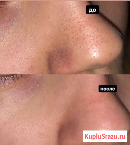 Чистка лица Иркутск - изображение 1