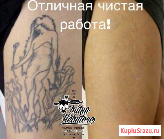 Удаление Тату Лазером спб Санкт-Петербург - изображение 1