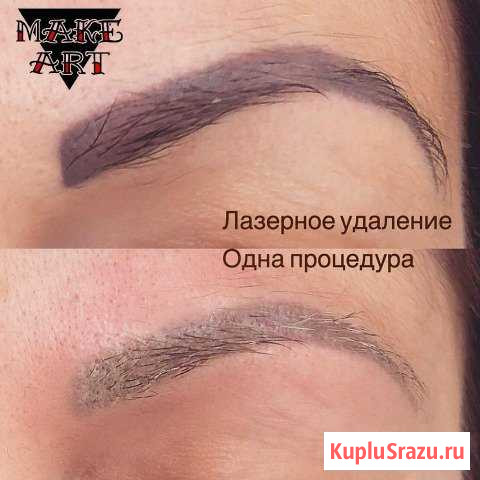 Лазерное удаление татуировок и татуажа Тюмень - изображение 1