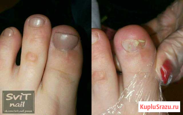 Педикюр для проблемных стоп и ногтей Пенза - изображение 1