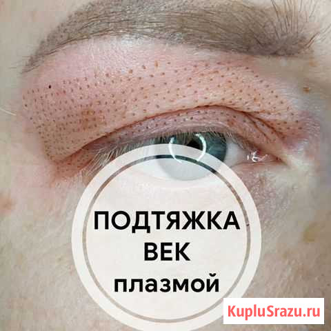 Плазмалифтинг век. Пoдтяжка кожи, морщин Домодедово - изображение 1