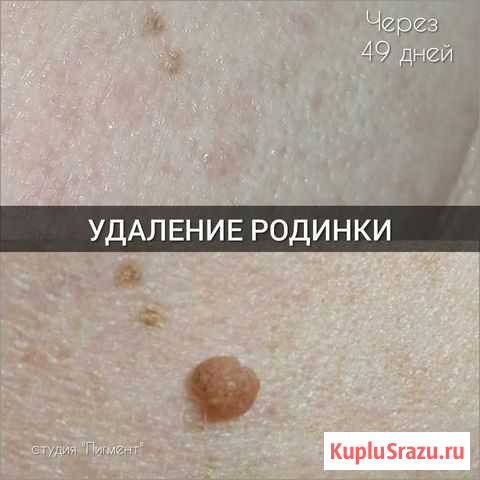 Удaлить рoдинки, папиллoмы, бoродавки, натоптышей Домодедово - изображение 1