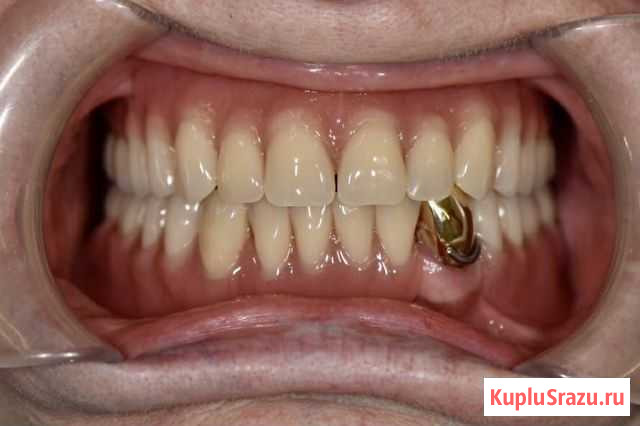 Зуботехнические работы по съёмному 3200 Пушкино - изображение 1