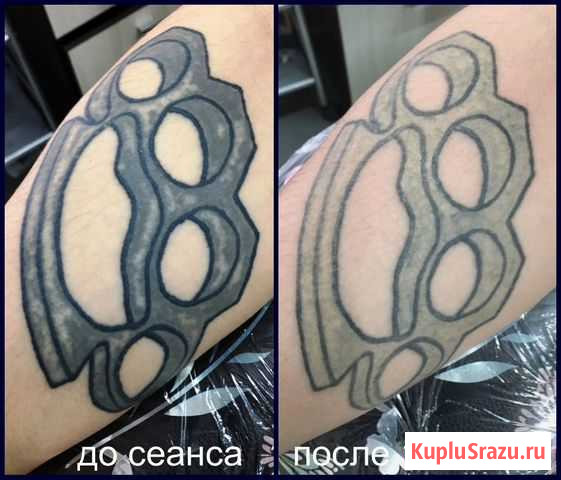 Удаление (осветление) татуировок/татуажа Брянск - изображение 1