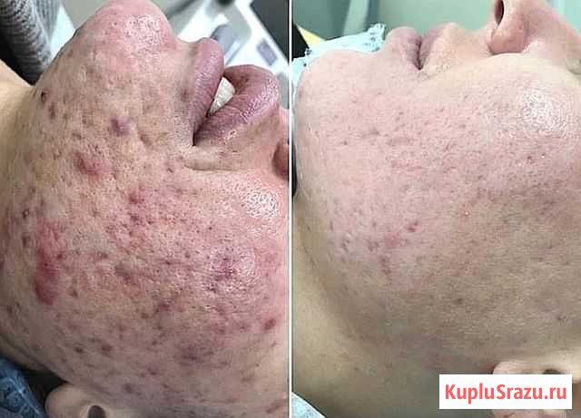 Лазерный пилинг. Fraxel Peel. FT Technology Петропавловск-Камчатский - изображение 1