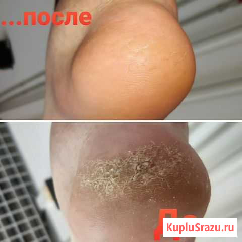 Педикюр аппаратный Волгоград - изображение 1
