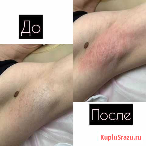 Электроэпиляция В центре города Астрахань - изображение 1