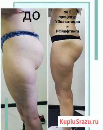Кавитация Похудеть рфлифтинг Худеем вакуум Белгород - изображение 1