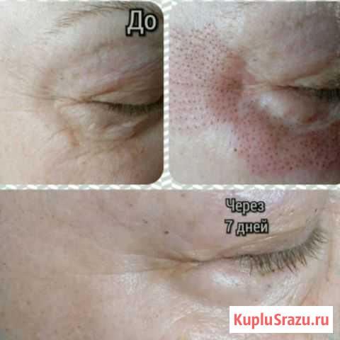 Плазменное омоложение Елизово - изображение 1