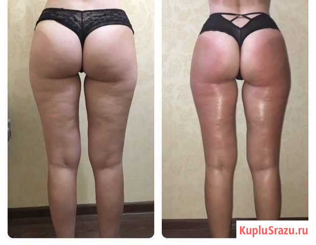Кавитация+вакуум+RF-лифтинг Калуга - изображение 1