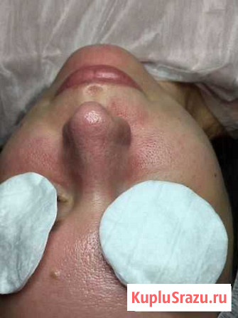 Комбинированная чистка лица Пушкино - изображение 1