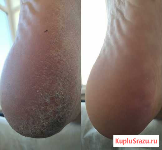 Педикюр Кострома - изображение 1