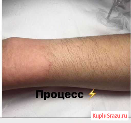 Электроэпиляция Кизилюрт - изображение 1